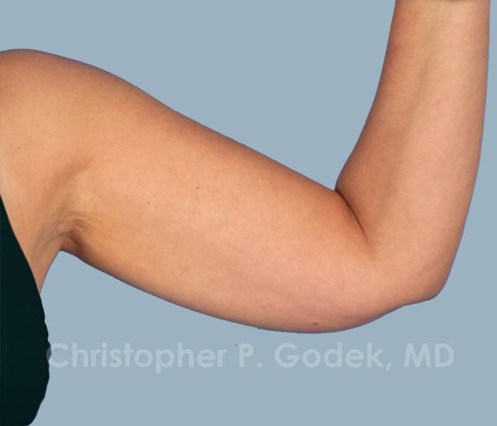 Arm Contouring Before & After Image