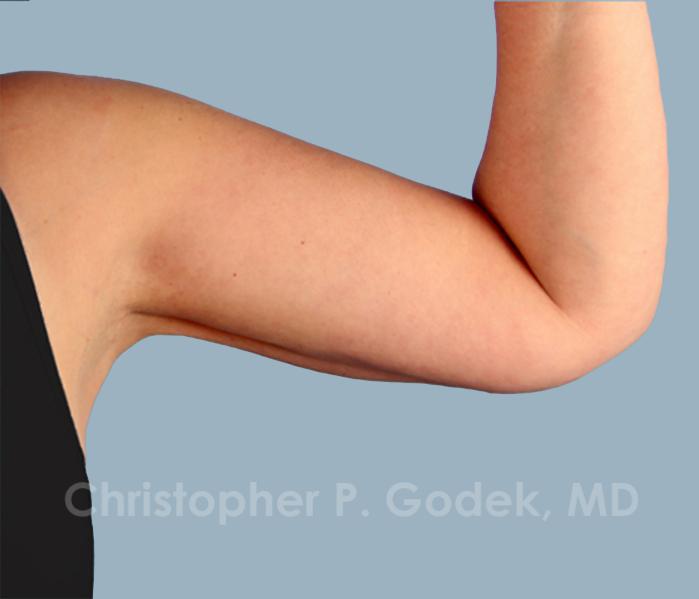 Arm Contouring Before & After Image