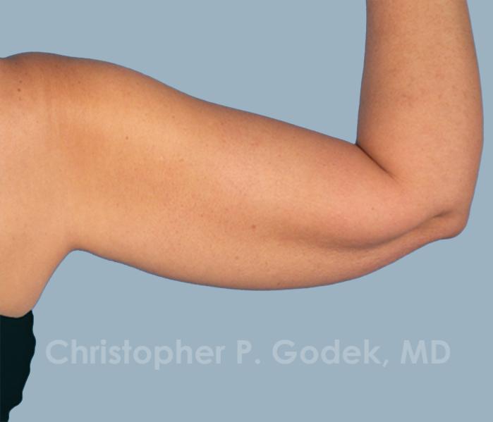 Arm Contouring Before & After Image