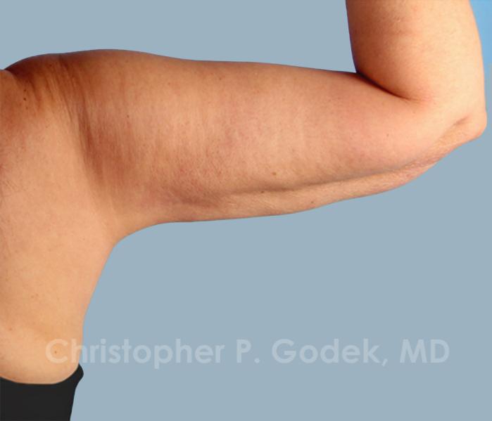 Arm Contouring Before & After Image