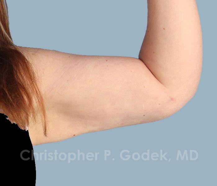 Arm Contouring Before & After Image