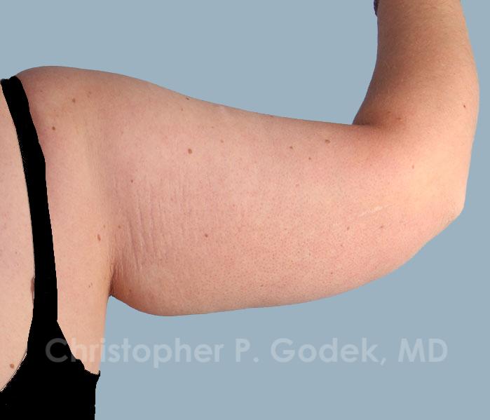 Arm Contouring Before & After Image