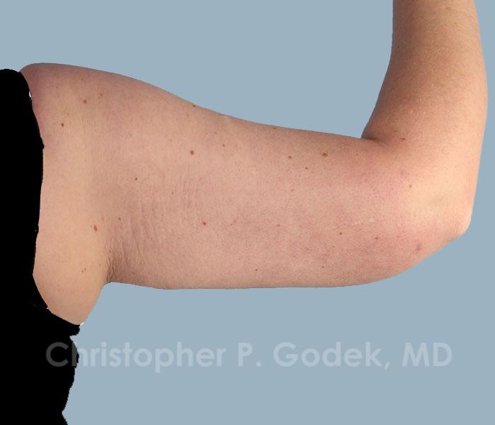 Arm Contouring Before & After Image