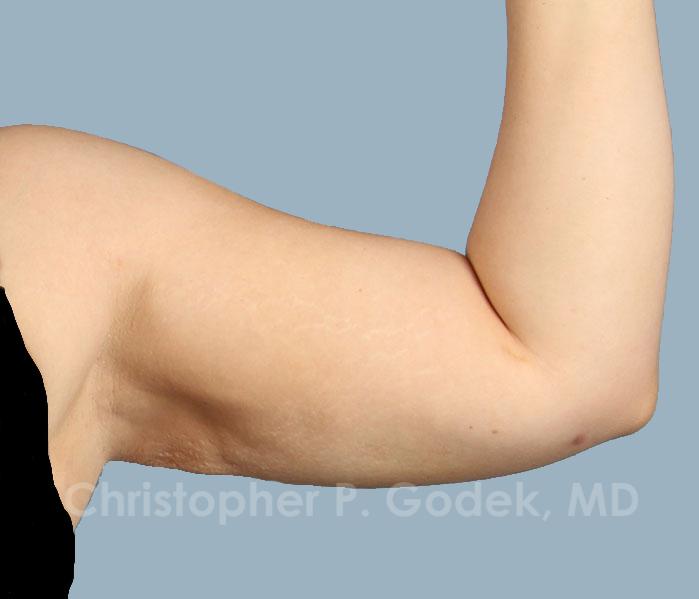 Arm Contouring Before & After Image