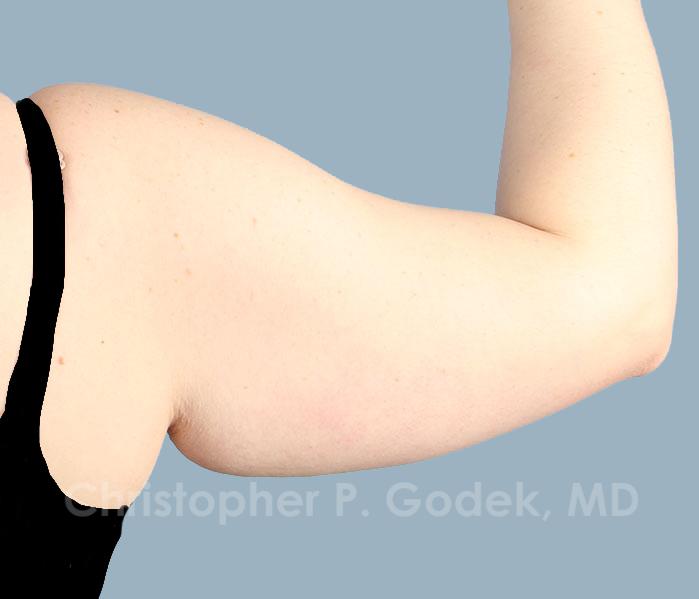 Arm Contouring Before & After Image