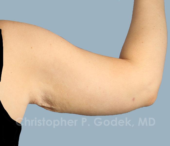 Arm Contouring Before & After Image