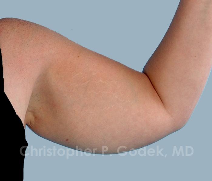 Arm Contouring Before & After Image