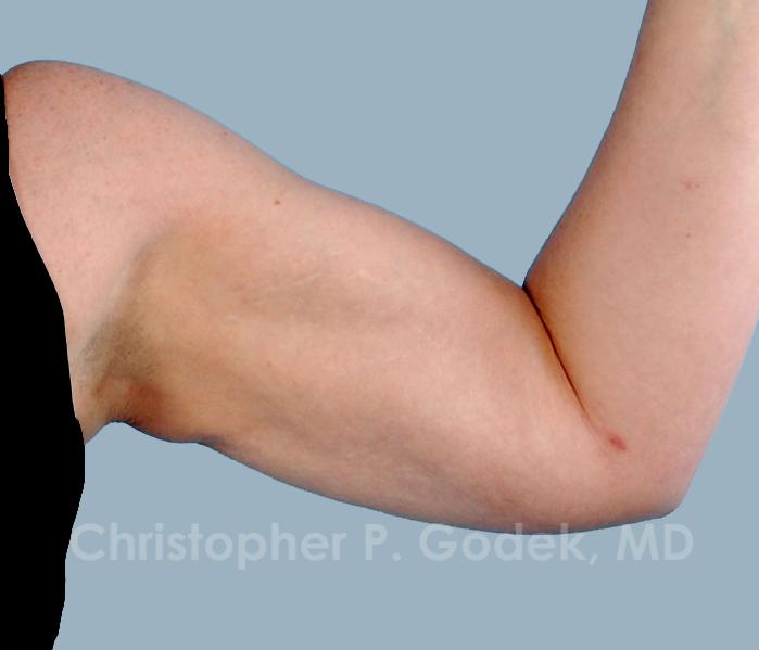 Arm Contouring Before & After Image