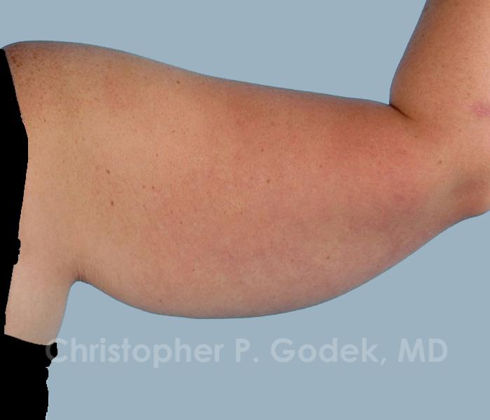 Arm Contouring Before & After Image