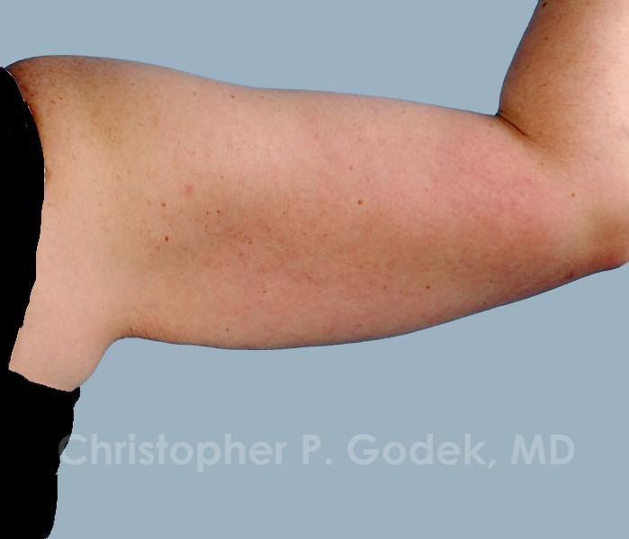 Arm Contouring Before & After Image