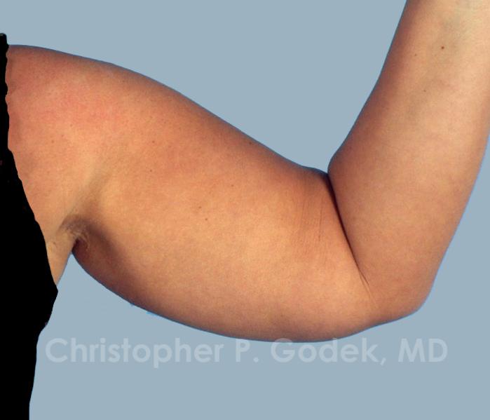 Arm Contouring Before & After Image