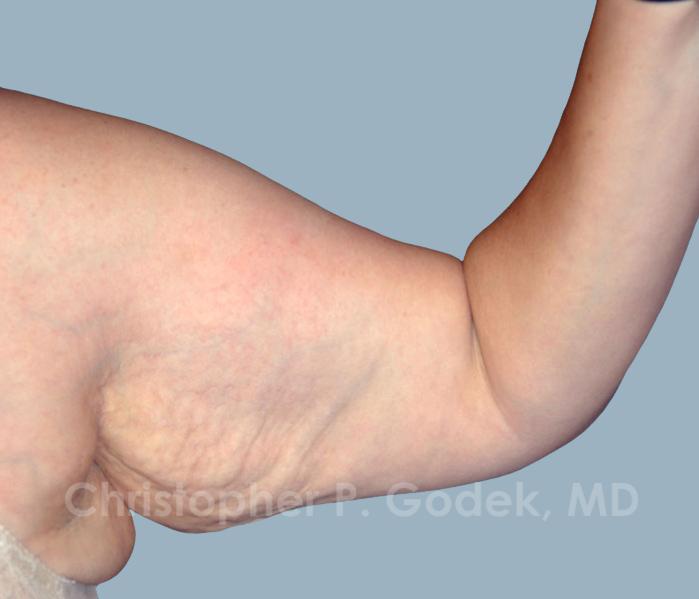 Arm Contouring Before & After Image