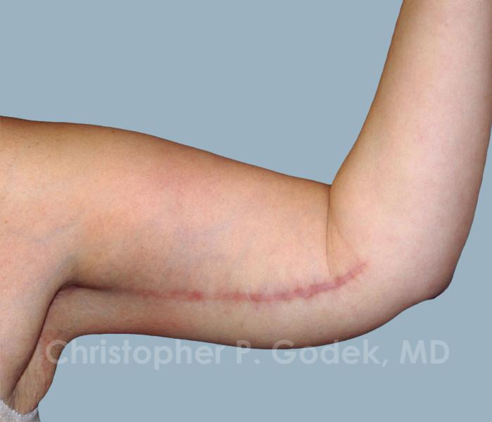Arm Contouring Before & After Image