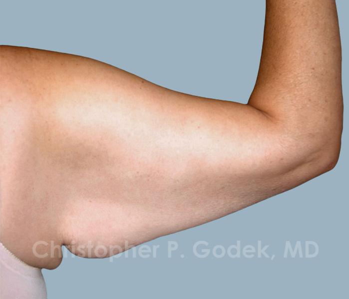 Arm Contouring Before & After Image