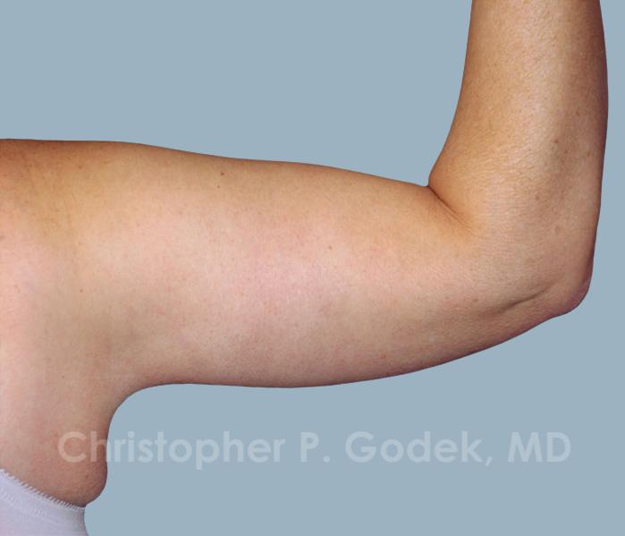 Arm Contouring Before & After Image