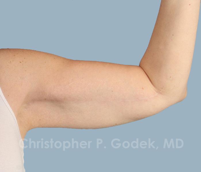 Arm Contouring Before & After Image