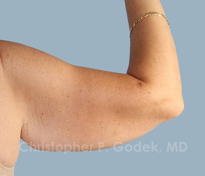 Arm Contouring Before & After Image