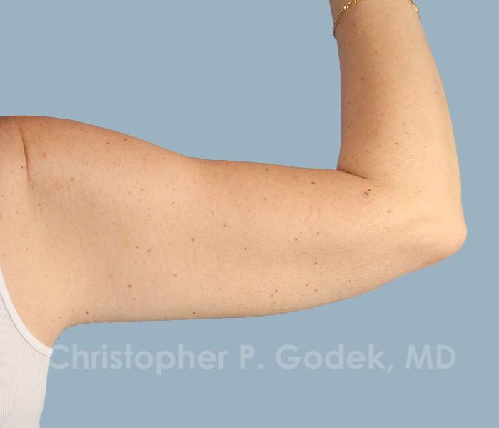 Arm Contouring Before & After Image