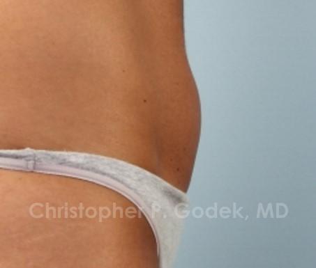 CoolSculpting Before & After Image