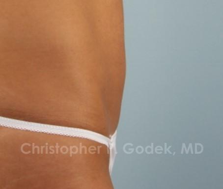 CoolSculpting Before & After Image