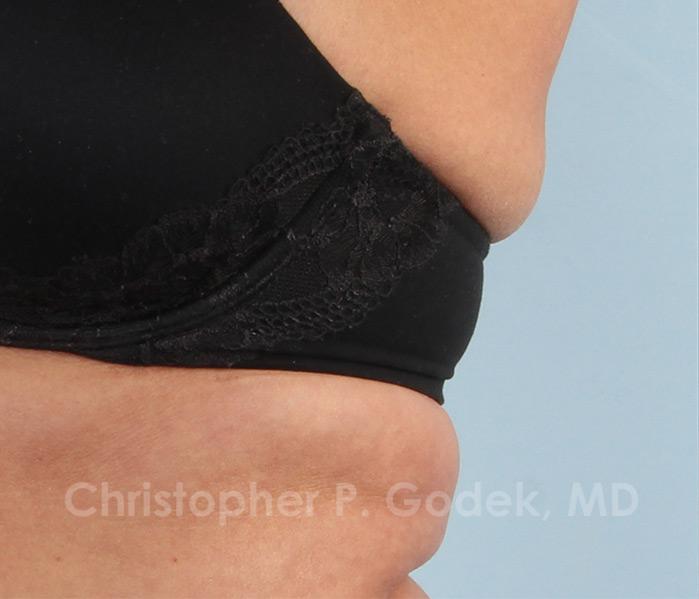 CoolSculpting Before & After Image