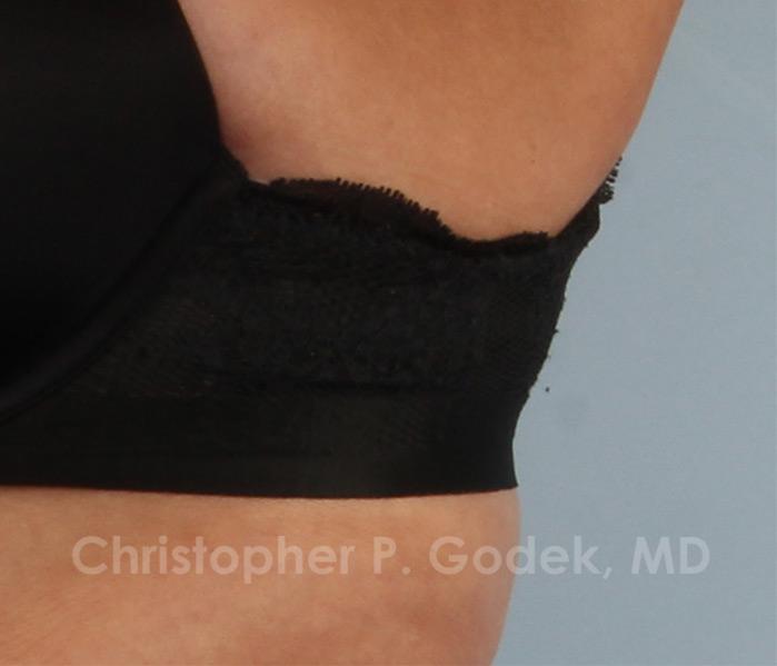 CoolSculpting Before & After Image