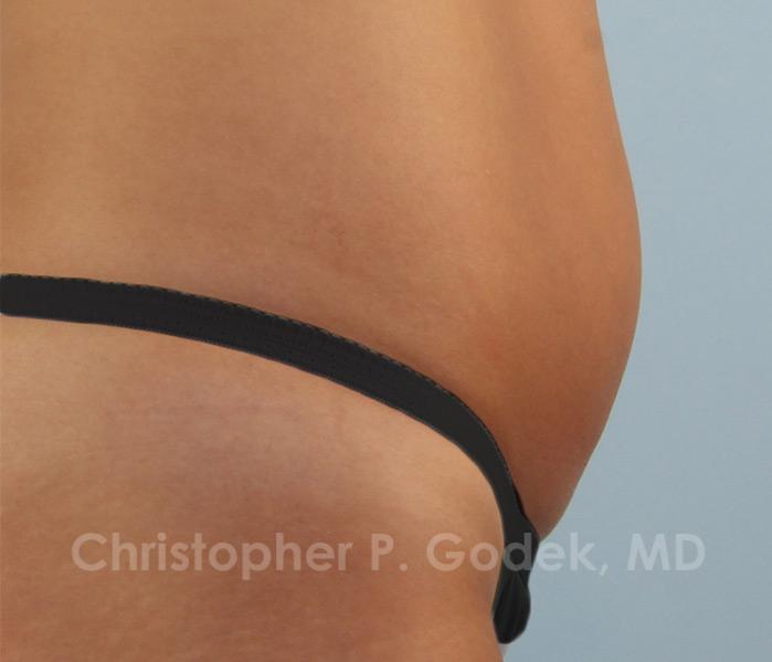 CoolSculpting Before & After Image