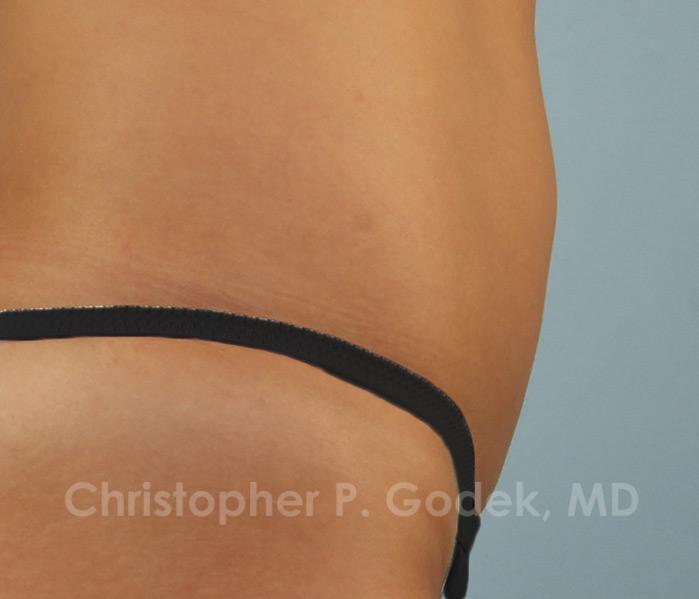 CoolSculpting Before & After Image