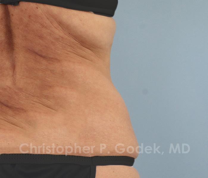 CoolSculpting Before & After Image