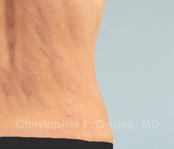 CoolSculpting Before & After Image