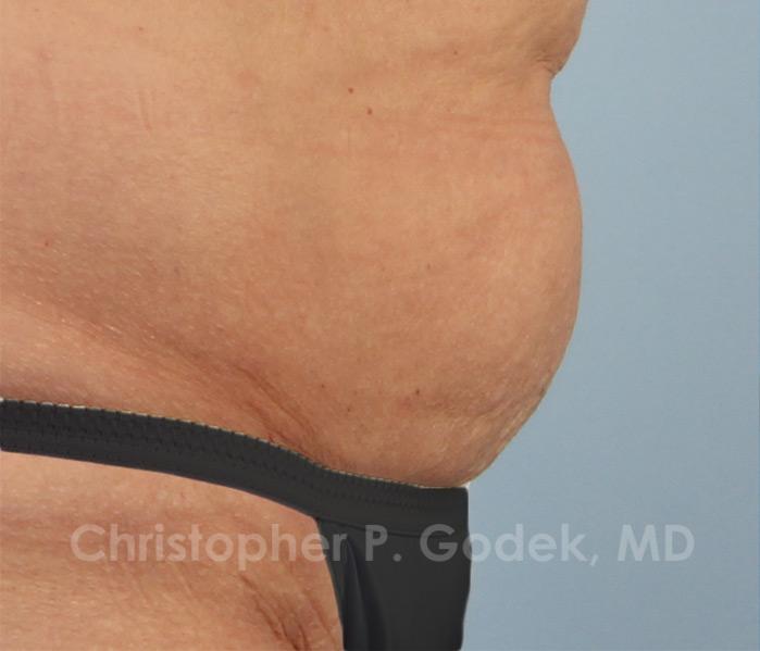 CoolSculpting Before & After Image