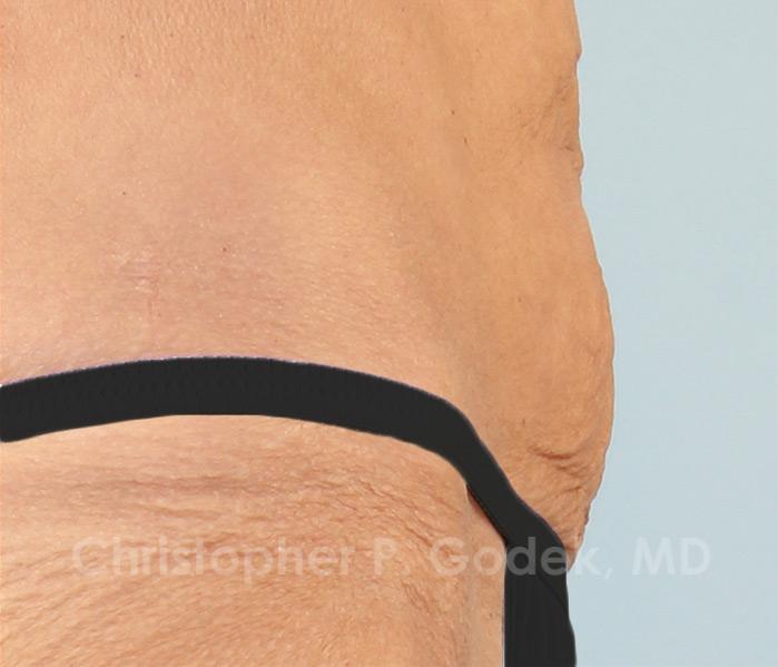 CoolSculpting Before & After Image