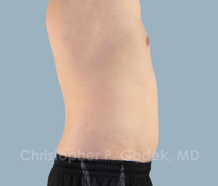 CoolSculpting Before & After Image