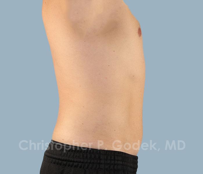 CoolSculpting Before & After Image