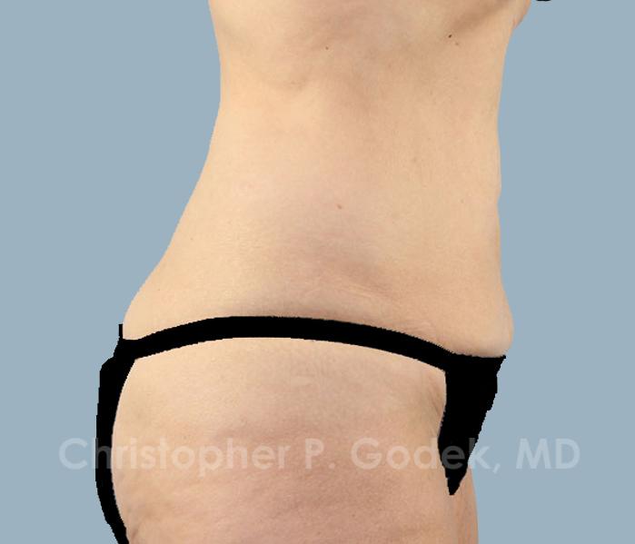 CoolSculpting Before & After Image