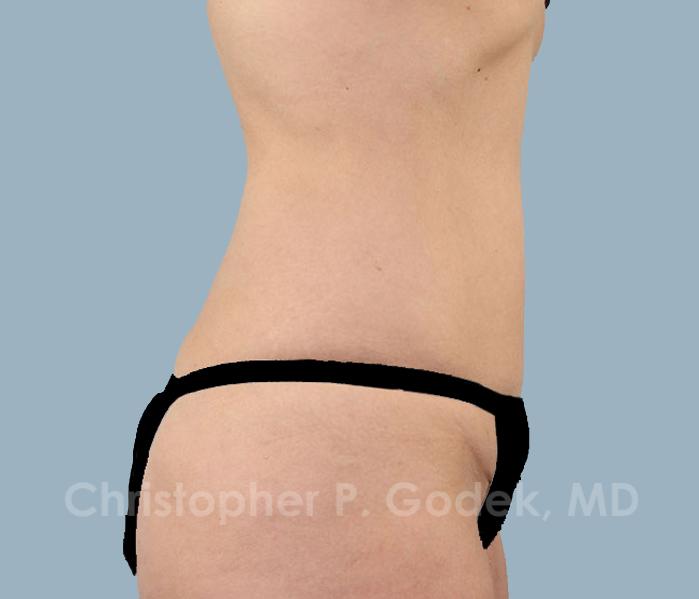 CoolSculpting Before & After Image