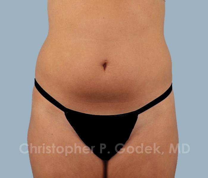 CoolSculpting Before & After Image