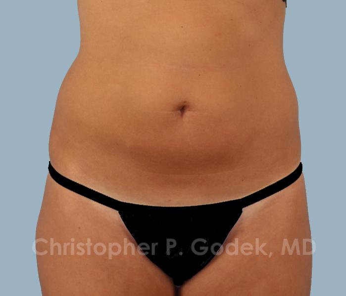 CoolSculpting Before & After Image