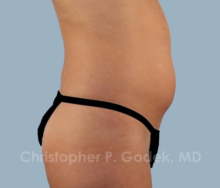 CoolSculpting Before & After Image