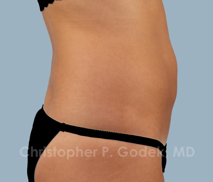 CoolSculpting Before & After Image