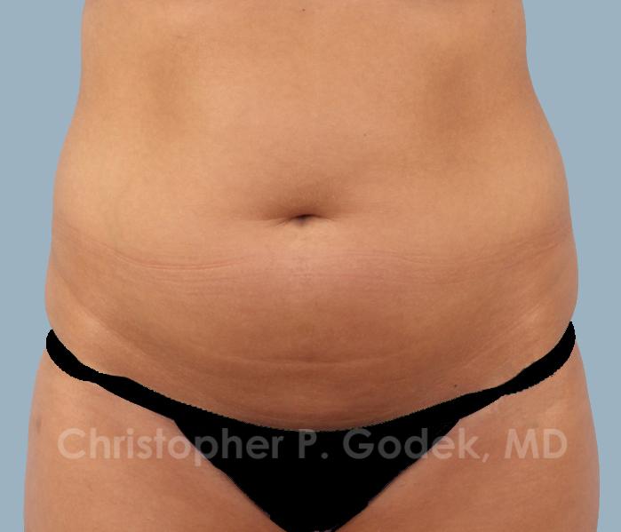 CoolSculpting Before & After Image