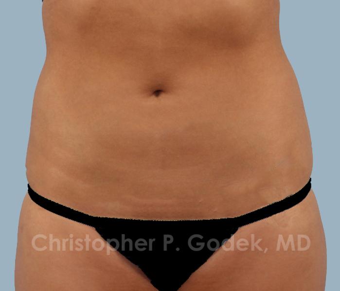 CoolSculpting Before & After Image