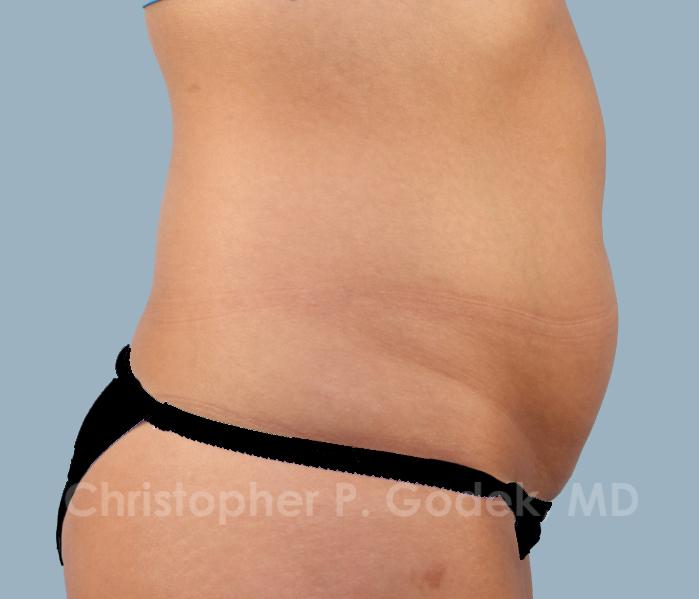 CoolSculpting Before & After Image