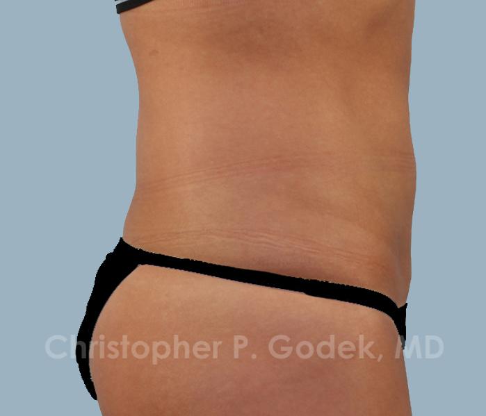 CoolSculpting Before & After Image