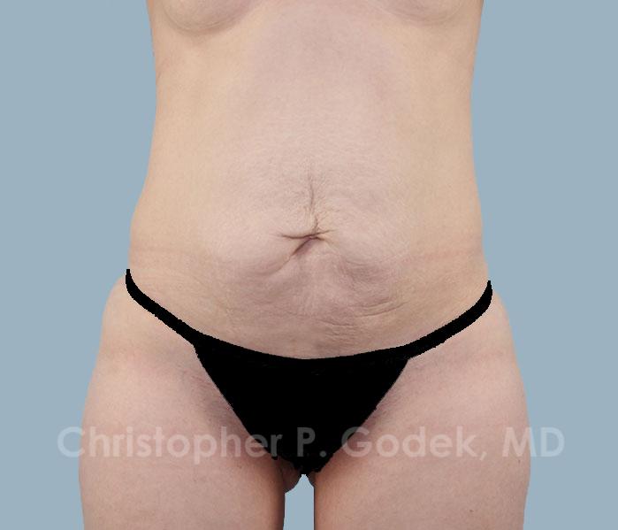 Tummy Tuck Before & After Image