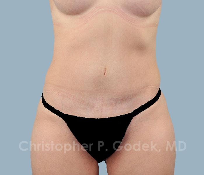 Tummy Tuck Before & After Image