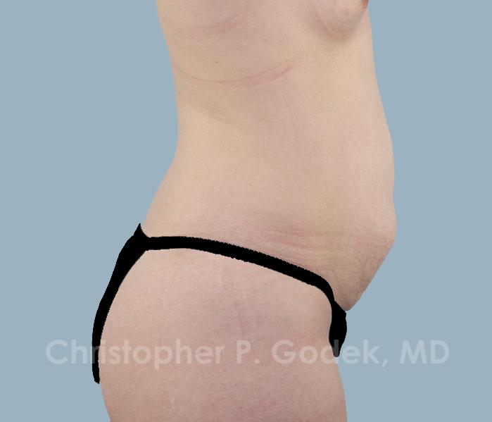 Tummy Tuck Before & After Image