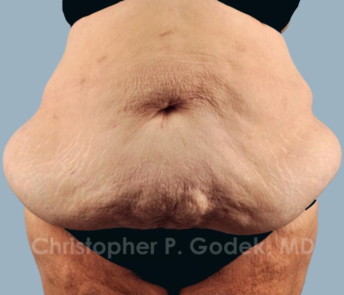 Tummy Tuck Before & After Image
