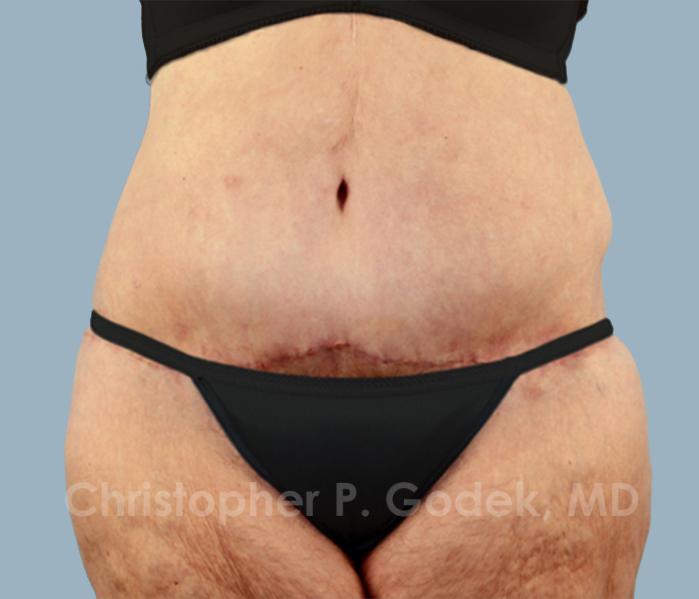 Tummy Tuck Before & After Image
