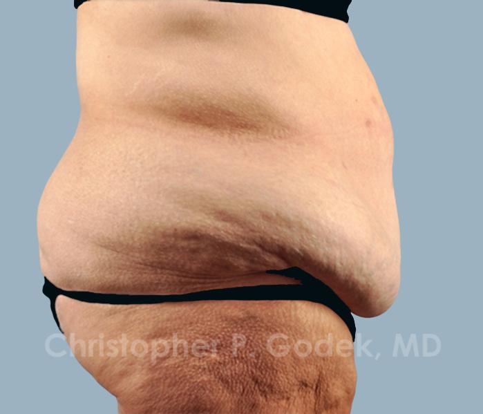 Tummy Tuck Before & After Image